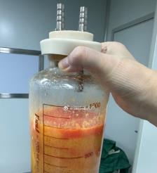 宣威水动力吸脂手术要做多久？